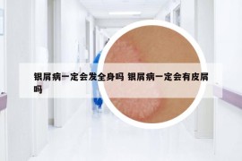 銀屑病一定會發(fā)全身嗎 銀屑病一定會有皮屑嗎