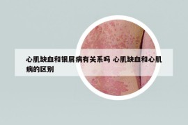 心肌缺血和銀屑病有關(guān)系嗎 心肌缺血和心肌病的區(qū)別