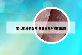 東北銀屑病醫(yī)院 吉林看銀屑病的醫(yī)院