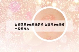 白癜風(fēng)照308用抹藥嗎 白斑用308治療一般照幾次
