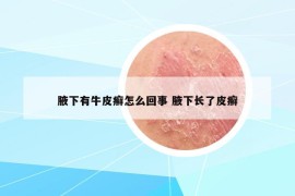 腋下有牛皮癬怎么回事 腋下長了皮癬