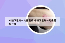 小孩下巴紅一片像是癬 小孩下巴紅一片像是癬一樣