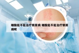 硼酸能不能治療銀屑病 硼酸能不能治療銀屑病呢
