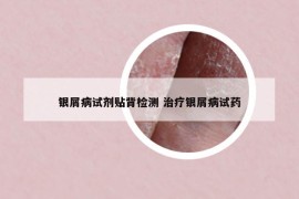 銀屑病試劑貼背檢測 治療銀屑病試藥