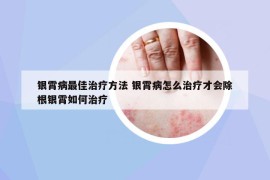 銀霄病最佳治療方法 銀霄病怎么治療才會(huì)除根銀霄如何治療