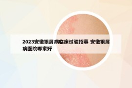 2023安徽銀屑病臨床試驗(yàn)招募 安徽銀屑病醫(yī)院哪家好