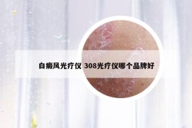 白癜風(fēng)光療儀 308光療儀哪個(gè)品牌好