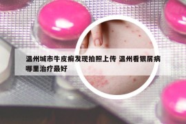 溫州城市牛皮癬發(fā)現(xiàn)拍照上傳 溫州看銀屑病哪里治療最好