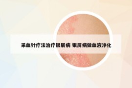 采血針療法治療銀屑病 銀屑病做血液凈化