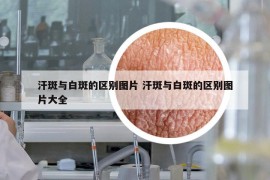 汗斑與白斑的區(qū)別圖片 汗斑與白斑的區(qū)別圖片大全