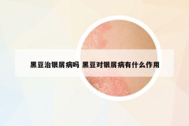 黑豆治銀屑病嗎 黑豆對銀屑病有什么作用