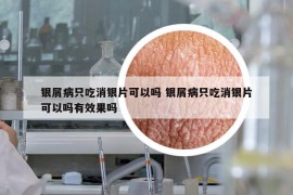 銀屑病只吃消銀片可以嗎 銀屑病只吃消銀片可以嗎有效果嗎