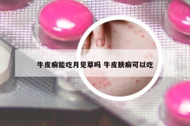 牛皮癬能吃月見草嗎 牛皮膚癬可以吃