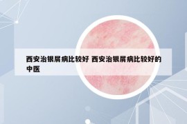 西安治銀屑病比較好 西安治銀屑病比較好的中醫(yī)