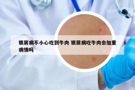 銀屑病不小心吃到牛肉 銀屑病吃牛肉會加重病情嗎