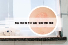 紫鹽銀屑病怎么治療 紫單銀屑膠囊