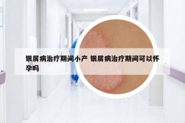 銀屑病治療期間小產(chǎn) 銀屑病治療期間可以懷孕嗎