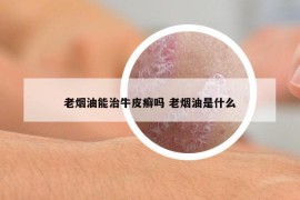 老煙油能治牛皮癬嗎 老煙油是什么