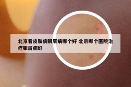 北京看皮膚病銀屑病哪個(gè)好 北京哪個(gè)醫(yī)院治療銀屑病好