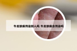 牛皮膚癬傳染別人嗎 牛皮膚癬會傳染嗎