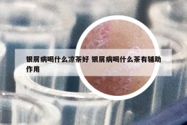 銀屑病喝什么涼茶好 銀屑病喝什么茶有輔助作用