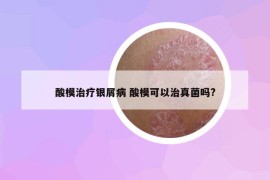 酸模治療銀屑病 酸?？梢灾握婢鷨?