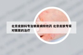 北京皮膚科專治銀屑病特效藥 北京皮膚專家對銀屑的治療