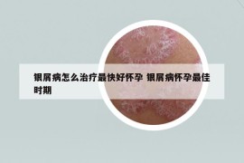 銀屑病怎么治療最快好懷孕 銀屑病懷孕最佳時(shí)期