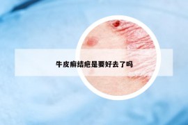 牛皮癬結(jié)疤是要好去了嗎
