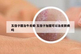 五倍子醋治牛皮癬 五倍子加醋可以治皮膚病嗎