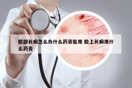 臉部長(zhǎng)癬怎么辦什么藥膏能用 臉上長(zhǎng)癬用什么藥膏