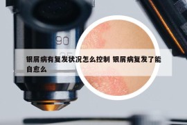 銀屑病有復(fù)發(fā)狀況怎么控制 銀屑病復(fù)發(fā)了能自愈么