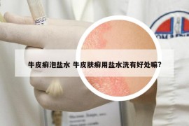 牛皮癬泡鹽水 牛皮膚癬用鹽水洗有好處嘛?