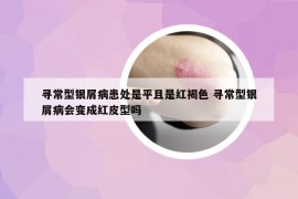 尋常型銀屑病患處是平且是紅褐色 尋常型銀屑病會變成紅皮型嗎
