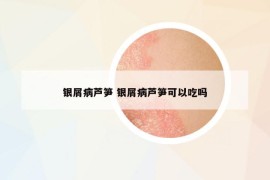 銀屑病蘆筍 銀屑病蘆筍可以吃嗎