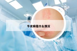 牛皮癬是什么情況