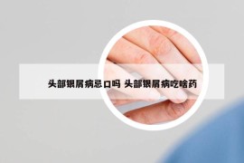 頭部銀屑病忌口嗎 頭部銀屑病吃啥藥