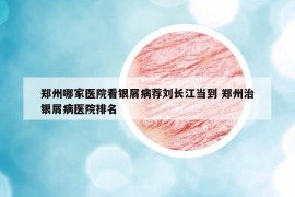 鄭州哪家醫(yī)院看銀屑病薦劉長江當?shù)?鄭州治銀屑病醫(yī)院排名