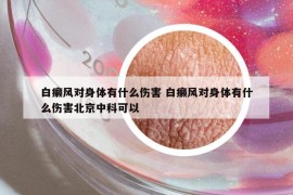 白癩風(fēng)對(duì)身體有什么傷害 白癩風(fēng)對(duì)身體有什么傷害北京中科可以