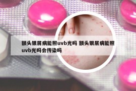 額頭銀屑病能照uvb光嗎 額頭銀屑病能照uvb光嗎會傳染嗎