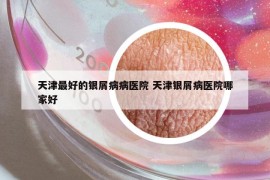 天津最好的銀屑病病醫(yī)院 天津銀屑病醫(yī)院哪家好