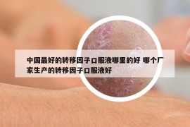 中國最好的轉移因子口服液哪里的好 哪個廠家生產(chǎn)的轉移因子口服液好