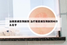 治銀屑病生物制劑 治療銀屑病生物制劑叫什么名字