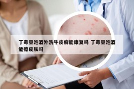 丁毒豆泡酒外洗牛皮癬能康復(fù)嗎 丁毒豆泡酒能擦皮膚嗎