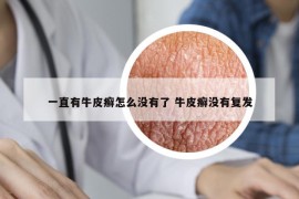 一直有牛皮癬怎么沒有了 牛皮癬沒有復(fù)發(fā)