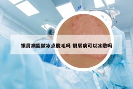 銀屑病能做冰點(diǎn)脫毛嗎 銀屑病可以冰敷嗎