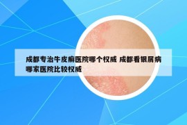 成都專治牛皮癬醫(yī)院哪個(gè)權(quán)威 成都看銀屑病哪家醫(yī)院比較權(quán)威