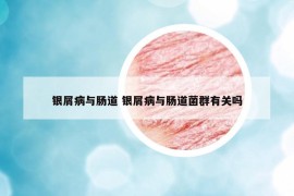 銀屑病與腸道 銀屑病與腸道菌群有關嗎