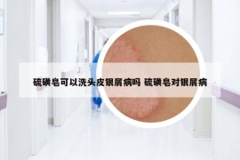 硫磺皂可以洗頭皮銀屑病嗎 硫磺皂對銀屑病