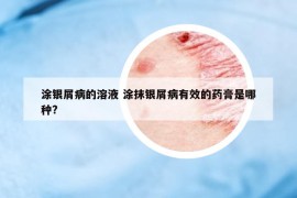 涂銀屑病的溶液 涂抹銀屑病有效的藥膏是哪種?